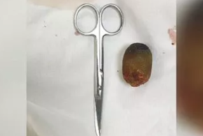 Краснодарские хирурги удалили огромный желчный камень пациентке с ожирением 