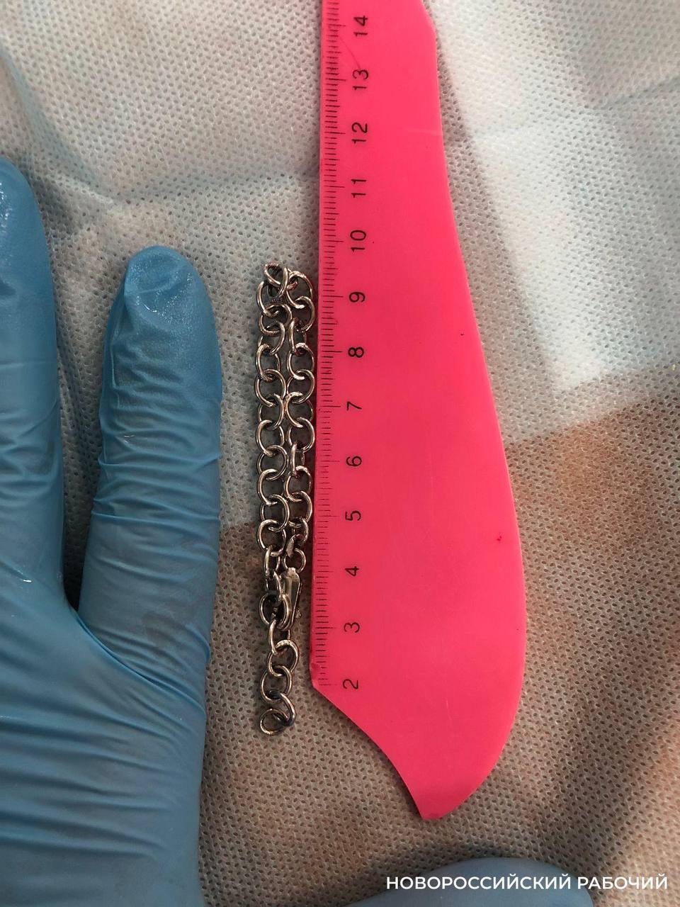 В кишечнике 5-летнего мальчика в Новороссийске нашли 19-сантиметровый браслет и паразитов