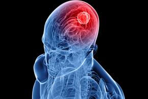 Онколог назвал самый распространенный симптом рака головного мозга